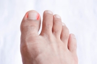 Possible Causes of Ingrown Toenails